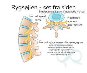 Rygsøjle med disc